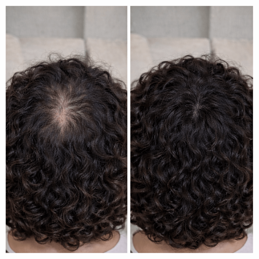 Antes e depois — resultado 6